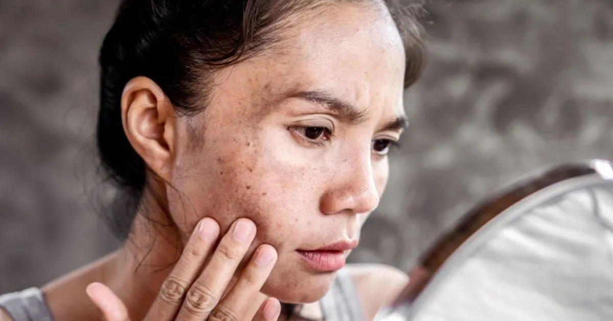 natural dark spot remover